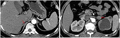 Case Report: Primary Aldosteronism and Subclinical Cushing Syndrome in a 49-Year-Old Woman With Hypertension Plus Hypokalaemia